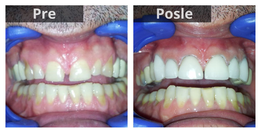 zubne fasete pre i posle