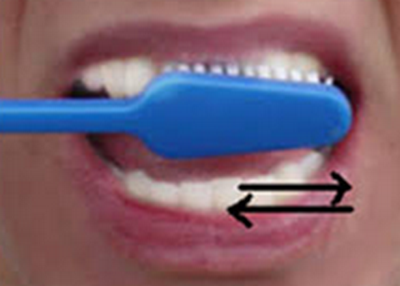 Nepravilno pranje zuba horizontalnim pokretima