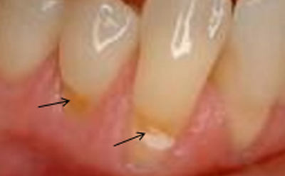 Oštećenje gleži zuba zbog nepravilnog pranja i tvrde četkice